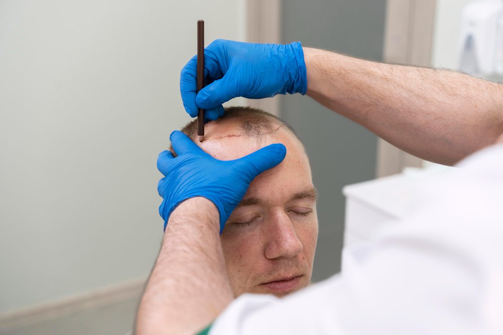 زراعة الشعر